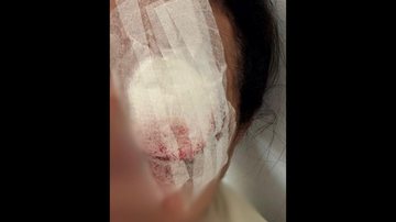 A idosa foi socorrida e passou por cirurgia, mas perdeu definitivamente a visão do olho atingido - Foto: Divulgação