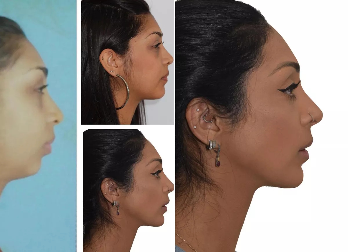 Antes e depois Amanda